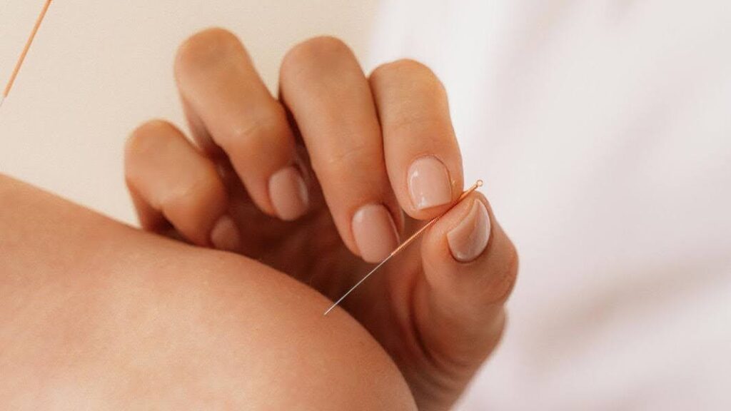 Acupuncture needles are carefully placed on the patient’s shoulder at Bespoke Wellness Alameda for stress relief and nervous system reset.